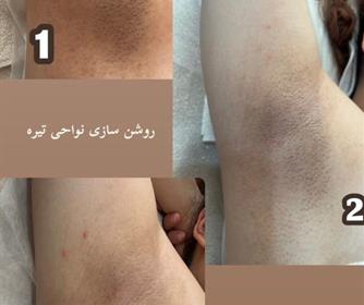 نمونه ای از پلاژن تراپی